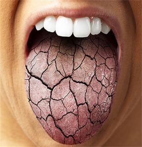 Dryness Of Mouth And Throat 115